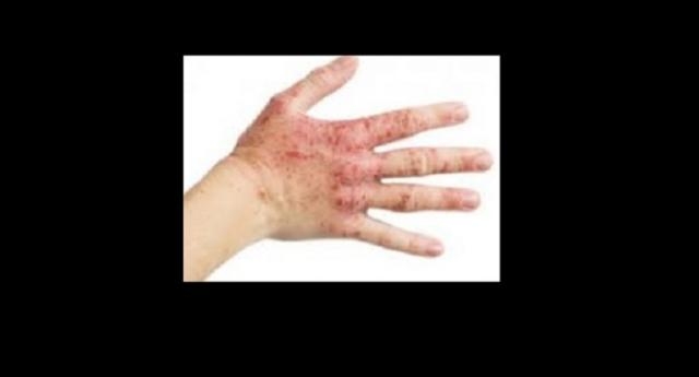 Come applicare semi di cardo a psoriasi