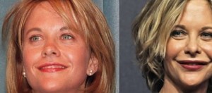 La actriz Meg Ryan antes y después de operarse.