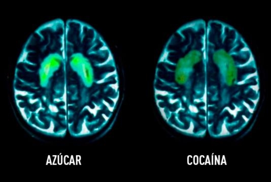 Efectos en el cerebro del azúcar y la cocaína