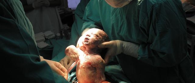 Parto cesárea cresce de forma descontrolada