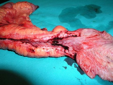 Malattia di Crohn - mariotrompetto.it