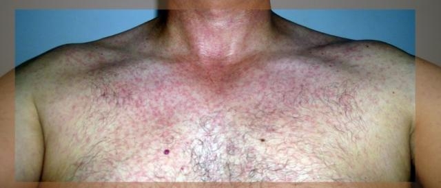 Studio dell'epidermide di uomo punto da zanzara