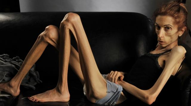 L'anoressia può portare alla morte