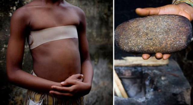 La pratica dello stiramento del seno, attuata principalmente in Camerun, si sta diffondendo anche in UK